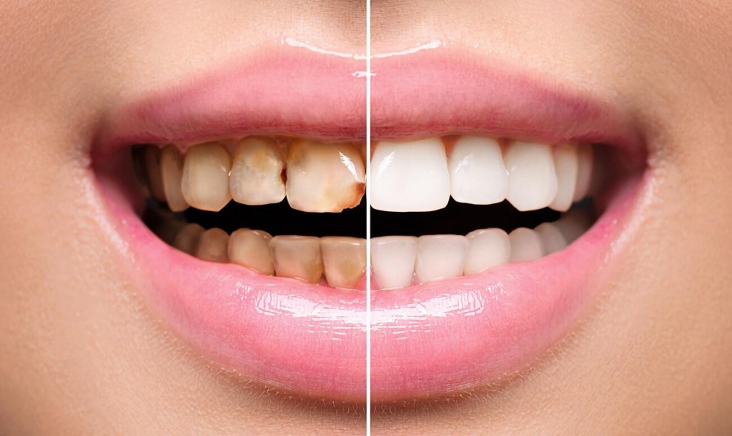 реставрация зубов.jpg